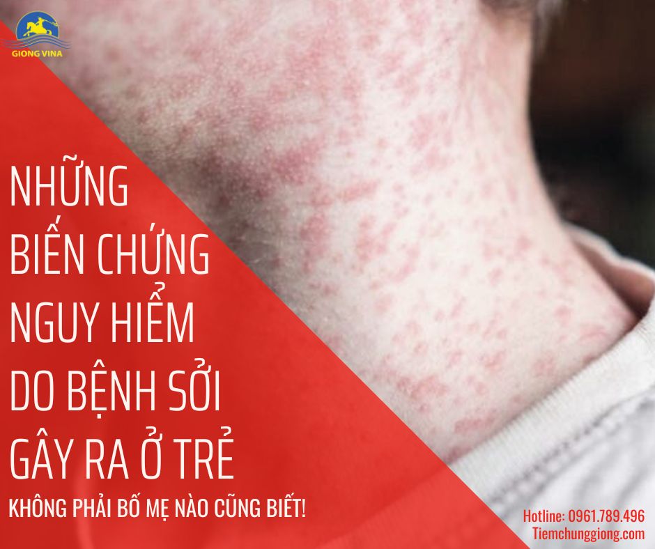 NHỮNG BIẾN CHỨNG NGUY HIỂM DO BỆNH SỞI GÂY RA Ở TRẺ KHÔNG PHẢI BỐ MẸ NÀO CŨNG BIẾT