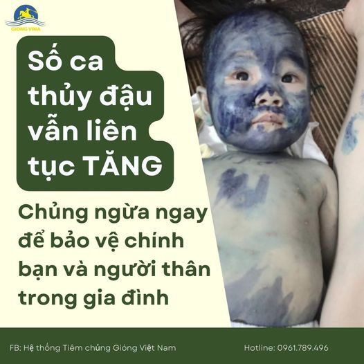 Số ca Thủy đậu vẫn liên tục tăng => CHỦNG NGỪA NGAY để bảo vệ chính bạn và người thân trong gia đình!!!