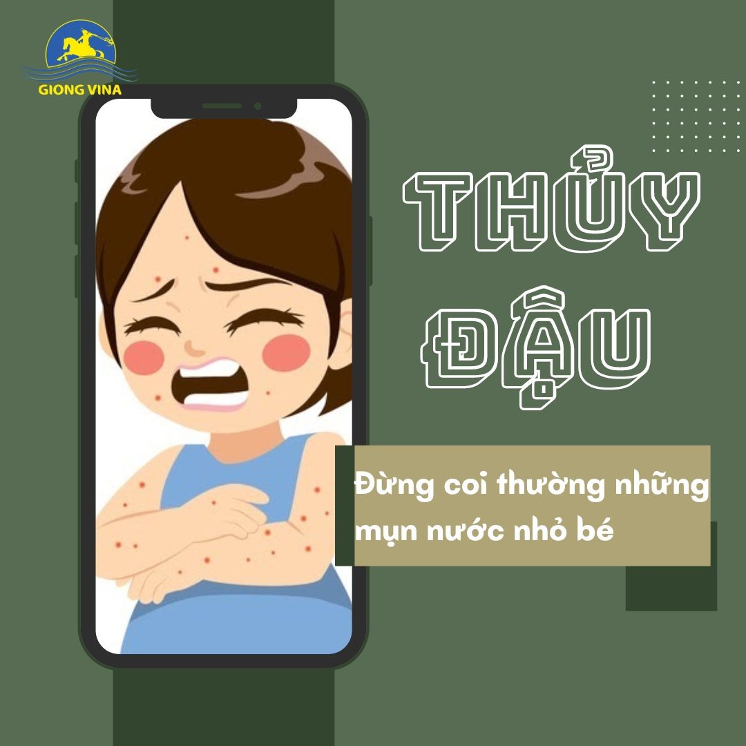 Thủy đậu – Đừng coi thường những mụn nước nhỏ bé