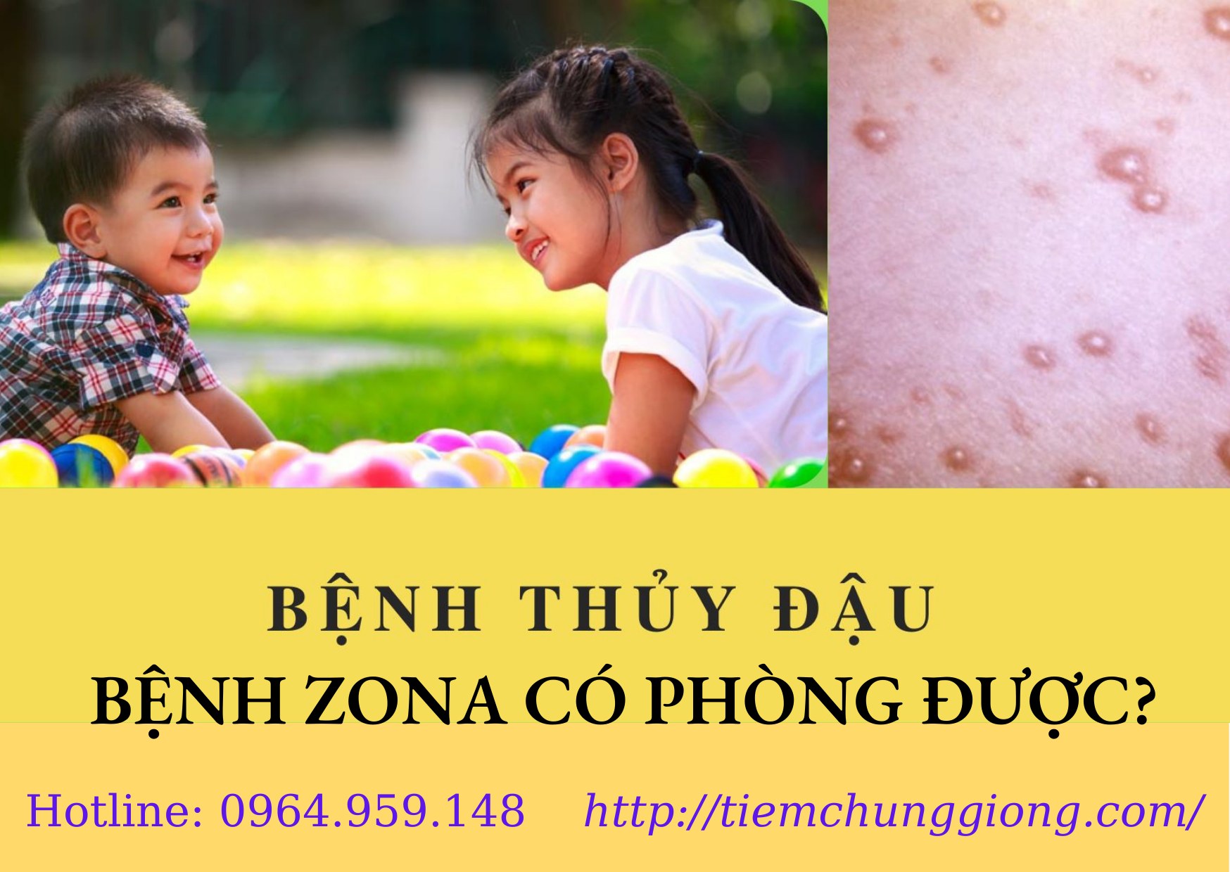 CÁCH PHÒNG BỆNH THỦY ĐẬU, BỆNH ZONA 