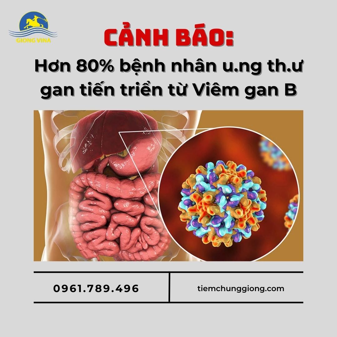 Cảnh báo: Hớn 80% bệnh nhân ung thư gan tiến triển từ Viêm gan B