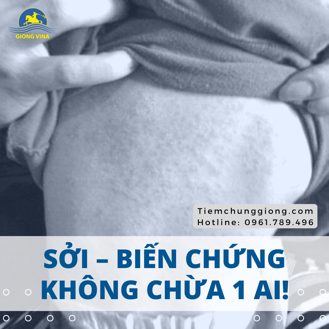 Sởi - Biến chứng không chừa 1 ai!