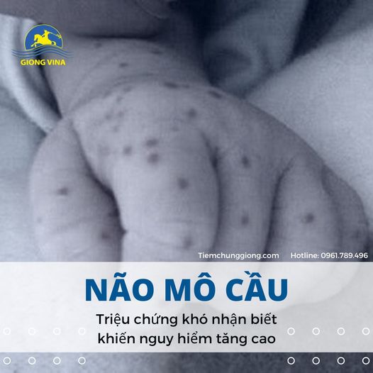 Não mô cầu - Triệu chứng khó nhận biết khiến nguy hiểm tăng cao