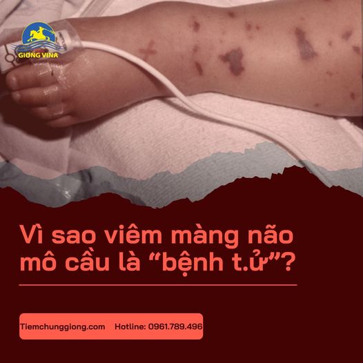 Vì sao viêm màng não mô cầu là 