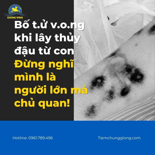 Bố t.ử v.o.ng khi lây thủy đậu từ con – Đừng nghĩ mình là người lớn mà chủ quan!