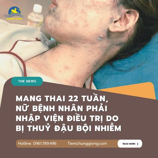 Mang thai 22 tuần, nữ bệnh nhân phải nhập viện điều trị do bị thuỷ đậu bội nhiễm