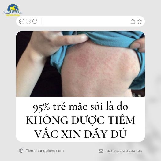 95% trẻ mắc sởi là do KHÔNG ĐƯỢC TIÊM VẮC XIN ĐẦY ĐỦ