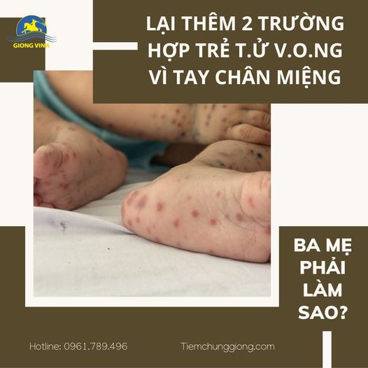 Lại thêm 2 trường hợp trẻ t.ử v.o.ng vì tay chân miệng: BA MẸ PHẢI LÀM SAO???