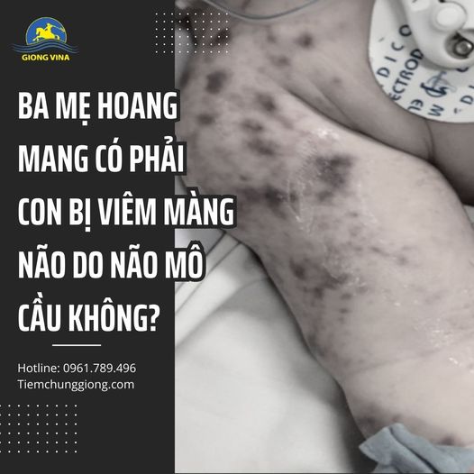 BA MẸ HOANG MANG CÓ PHẢI CON BỊ VIÊM MÀNG NÃO DO NÃO MÔ CẦU KHÔNG?