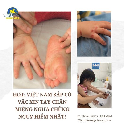 HOT: Việt Nam sắp có VẮC XIN TAY CHÂN MIỆNG ngừa chủng nguy hiểm nhất!