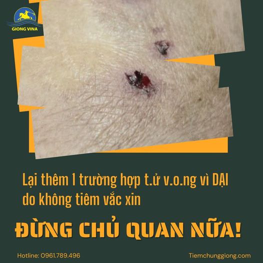 Lại thêm 1 trường hợp t.ử v.o.ng vì DẠI do không tiêm vắc xin – ĐỪNG CHỦ QUAN NỮA!!!