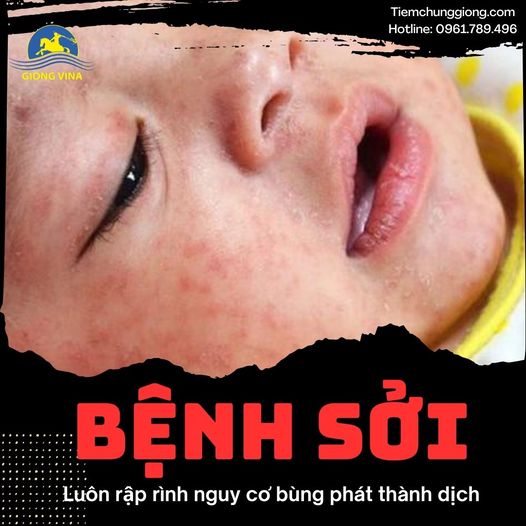 Bệnh Sởi – Luôn rập rình nguy cơ bùng phát thành dịch
