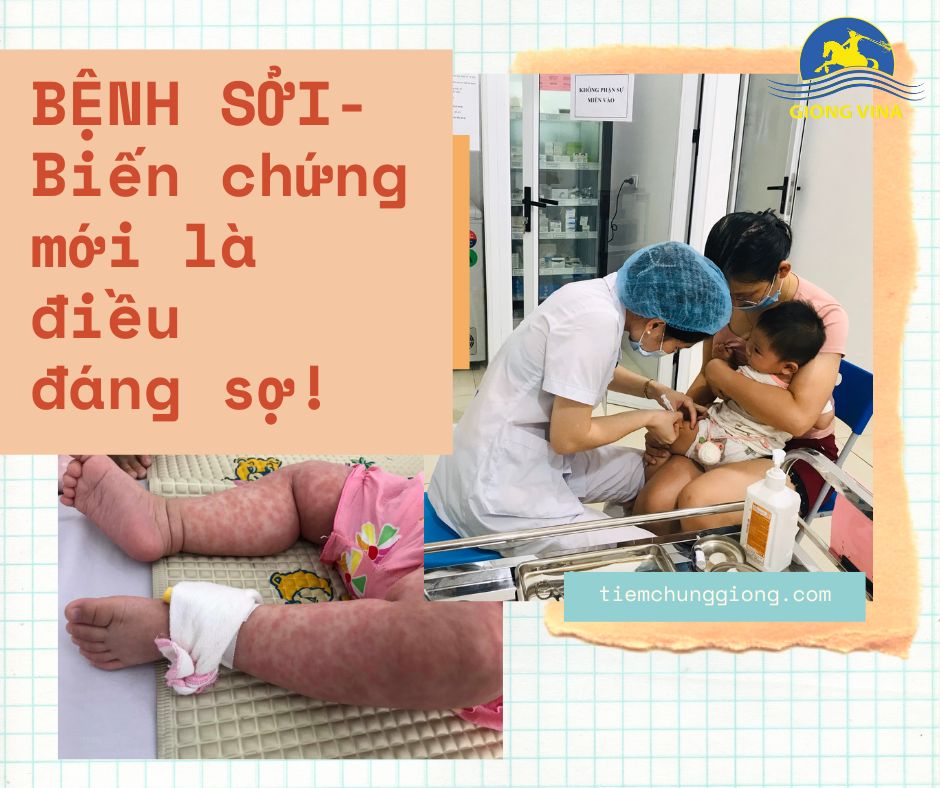 BỆNH SỞI – Biến chứng mới là điều đáng sợ!
