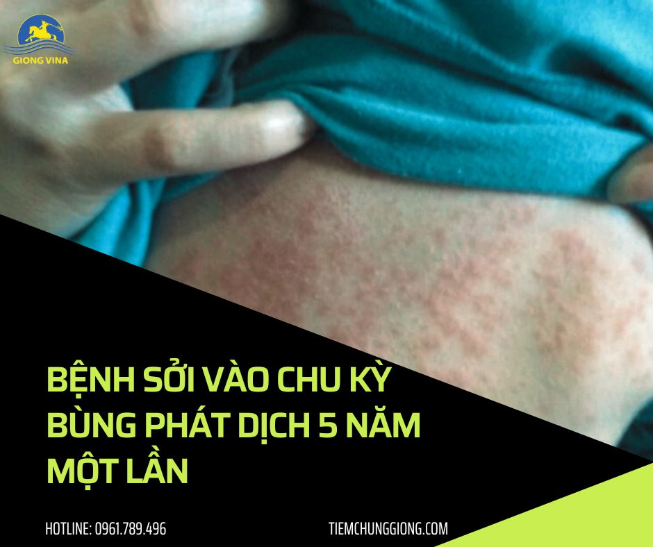 Bệnh sởi vào chu kỳ bùng phát dịch 5 năm một lần