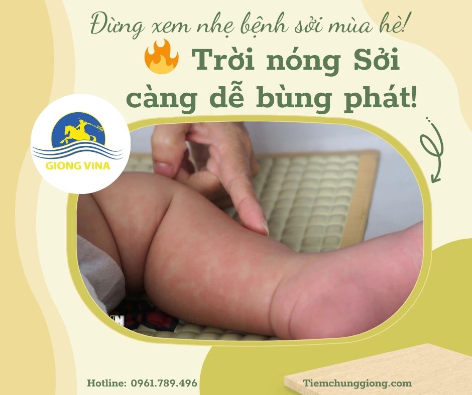  Đừng xem nhẹ bệnh sởi mùa hè!  Trời nóng – sởi càng dễ  bùng phát!
