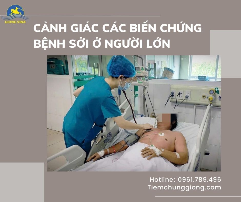 Cảnh giác các biến chứng bệnh sởi ở người lớn