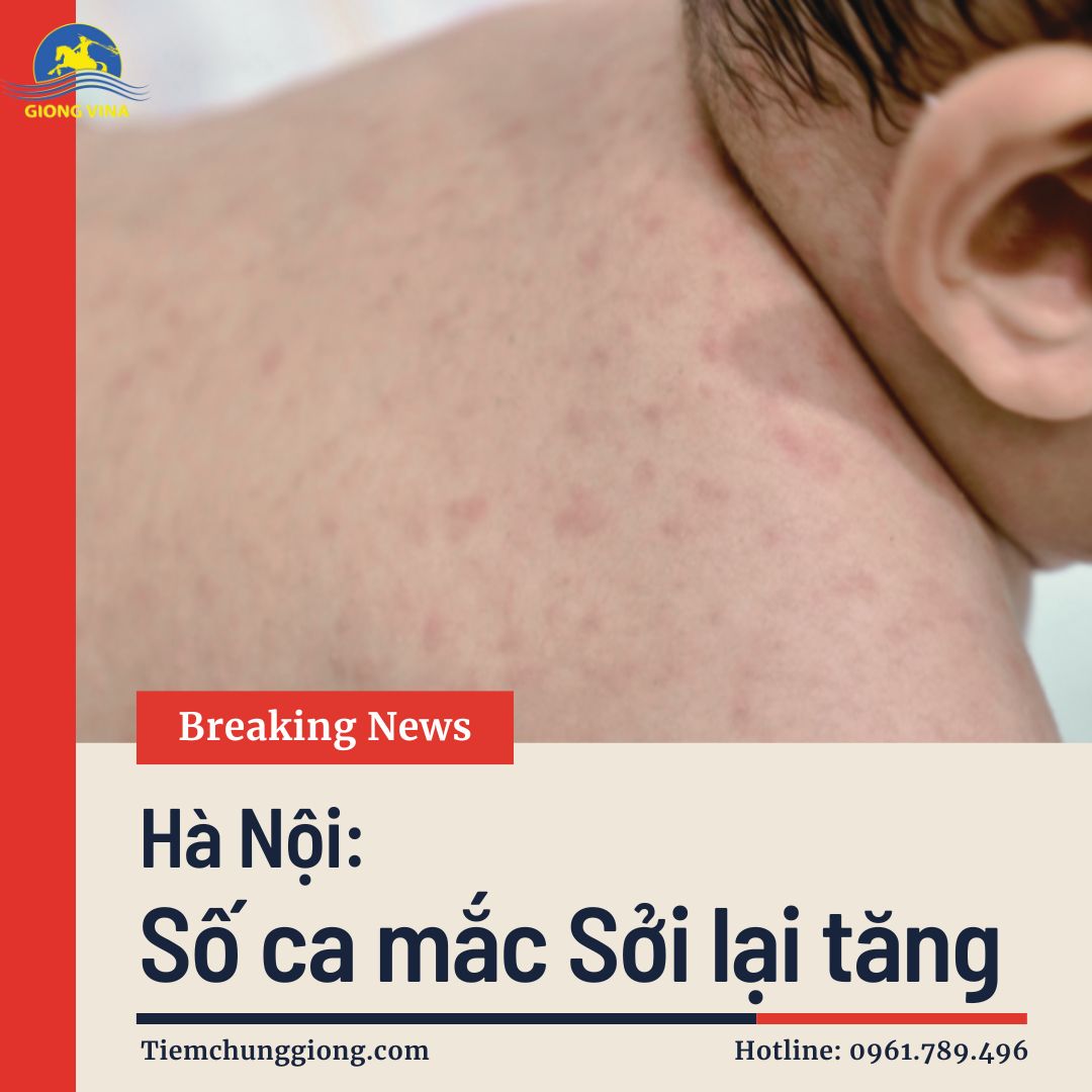 Hà Nội: Số ca mắc Sởi lại tăng