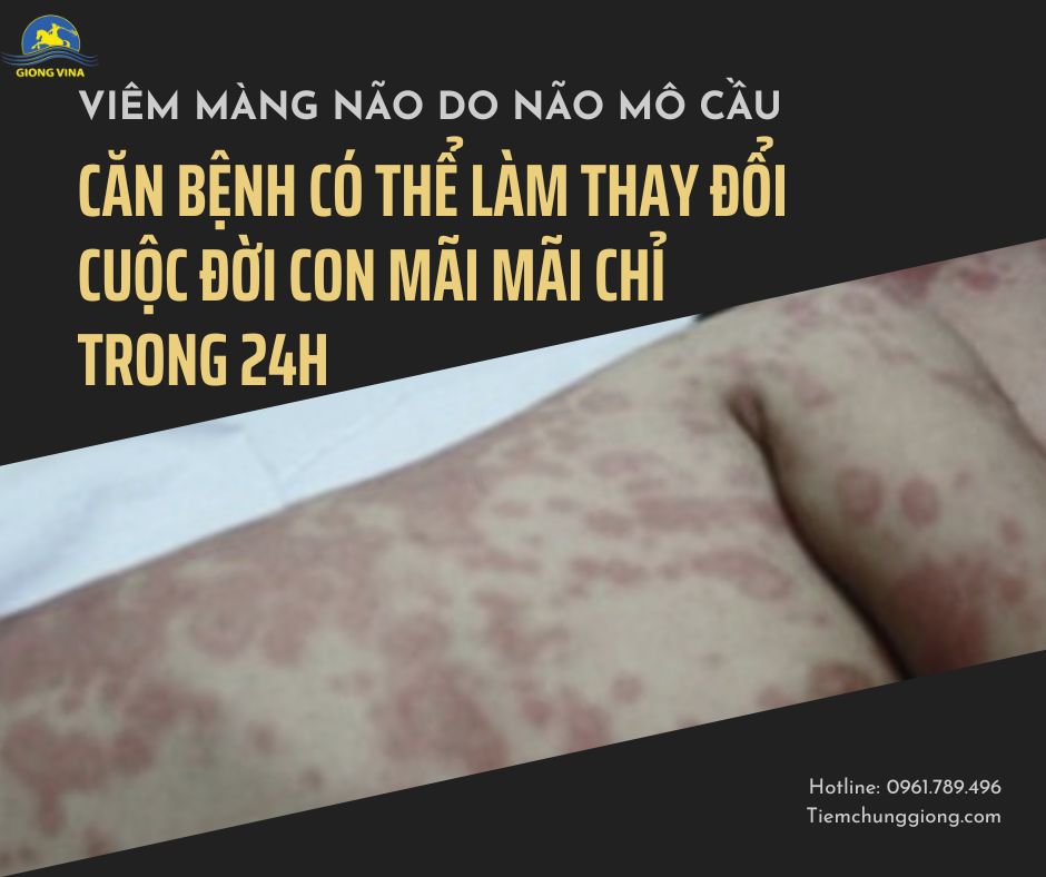VIÊM MÀNG NÃO DO NÃO MÔ CẦU – CĂN BỆNH CÓ THỂ LÀM THAY ĐỔI CUỘC ĐỜI CON MÃI MÃI CHỈ TRONG 24H