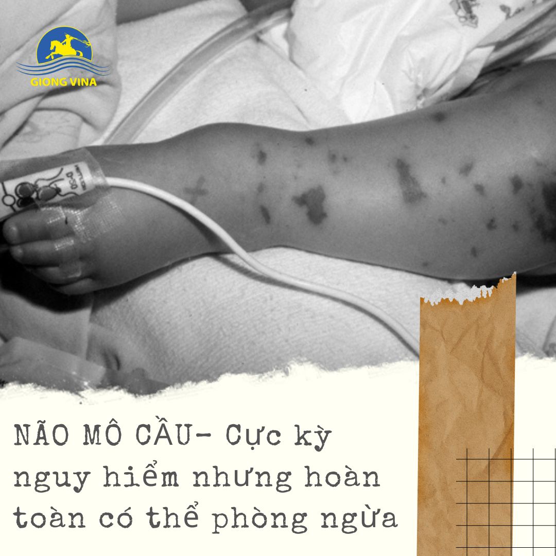 Não mô cầu – Cực kỳ nguy hiểm nhưng hoàn toàn có thể phòng ngừa