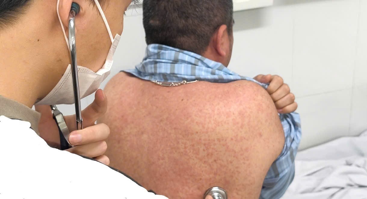 Người đàn ông nguy kịch vì sởi biến chứng