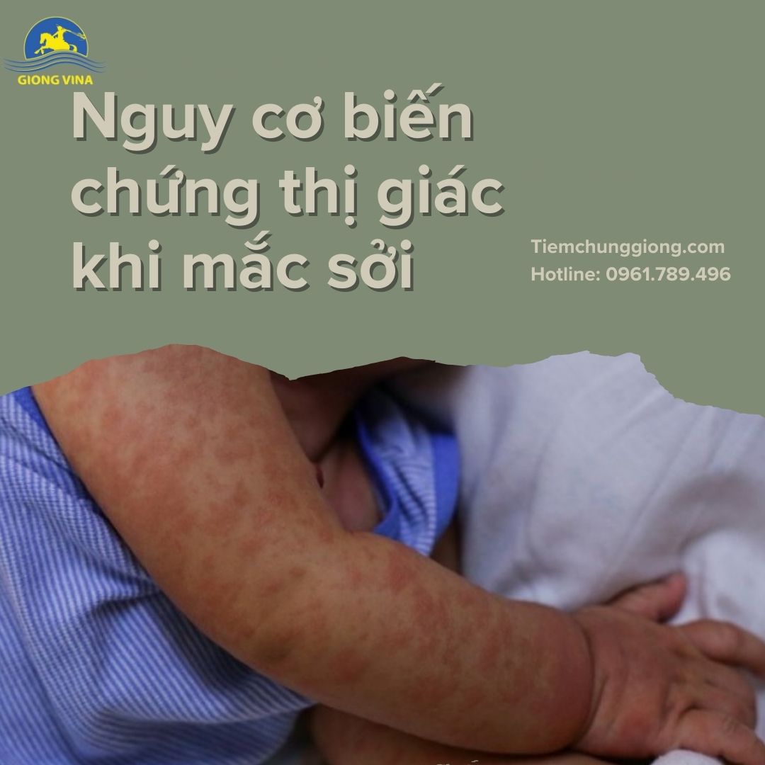 Nguy cơ biến chứng thị giác khi mắc sởi