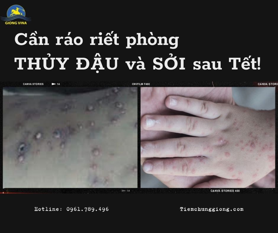Cần ráo riết phòng thủy đậu và sởi sau Tết!