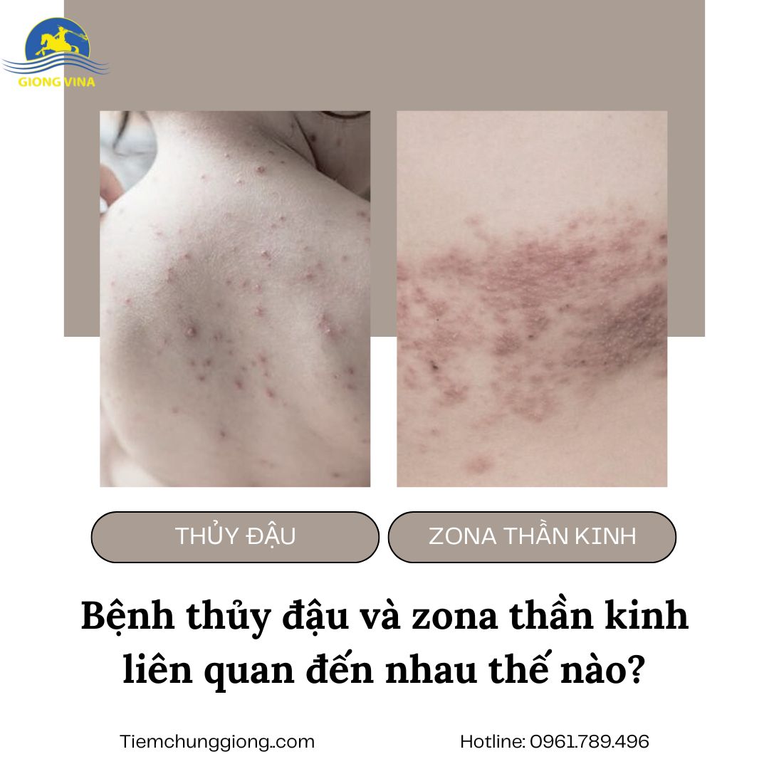 Bệnh thủy đậu và zona thần kinh liên quan đến nhau thế nào?