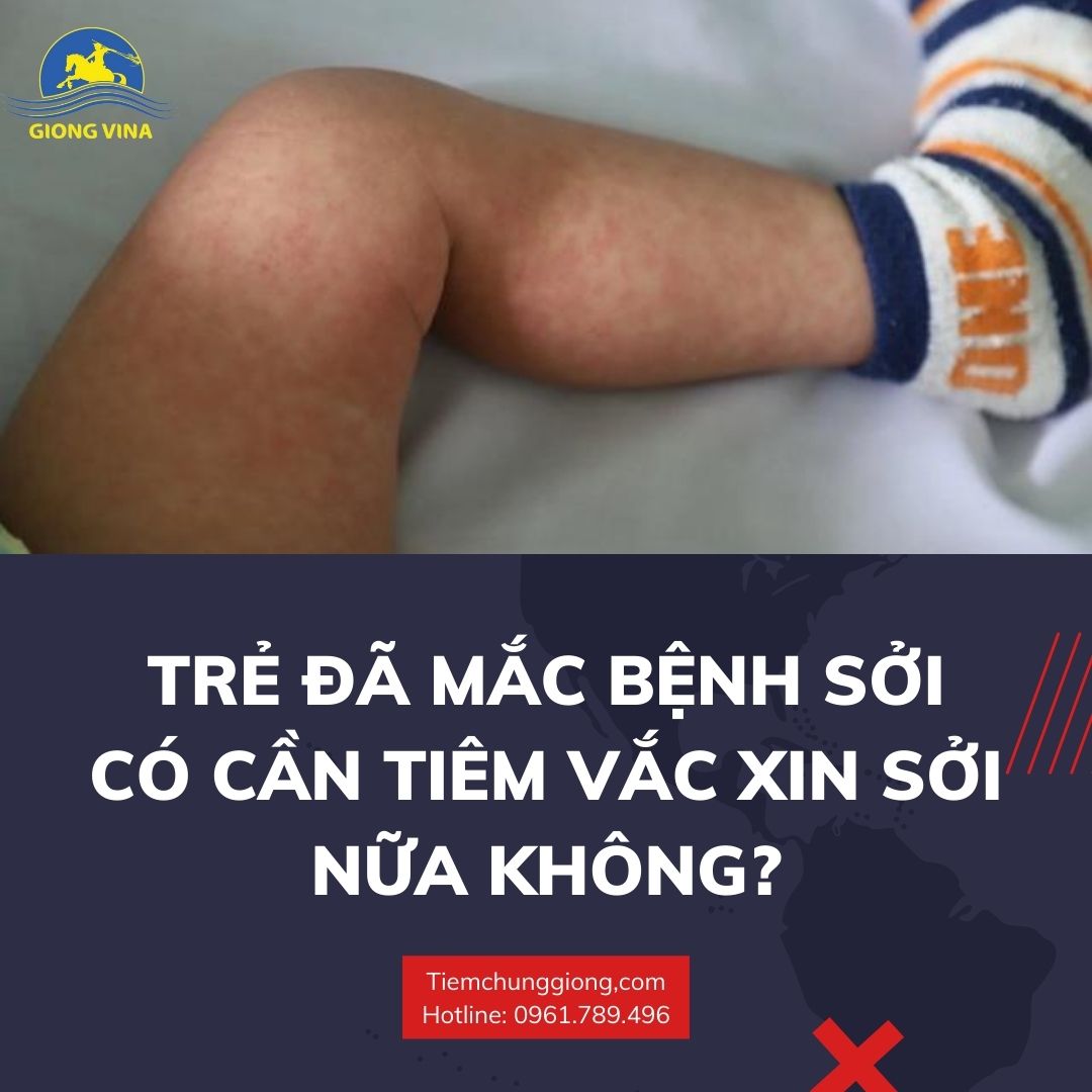 Trẻ đã mắc bệnh sởi có cần tiêm vắc xin sởi nữa không?