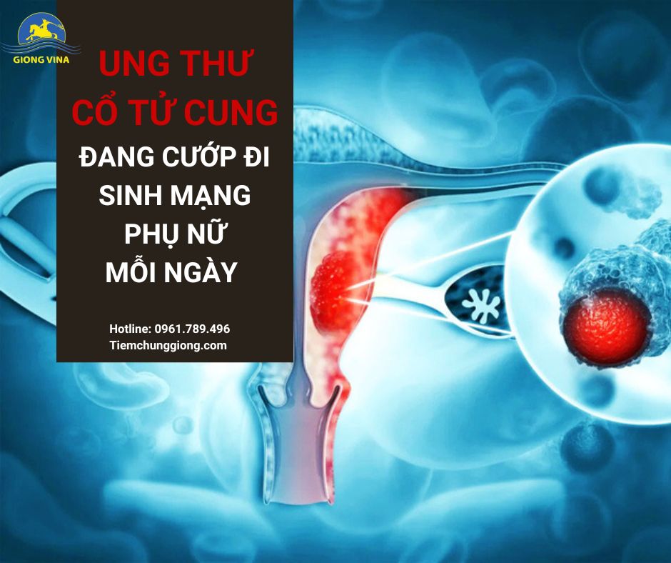 UNG THƯ CỔ TỬ CUNG ĐANG CƯỚP ĐI SINH MẠNG PHỤ NỮ MỖI NGÀY 