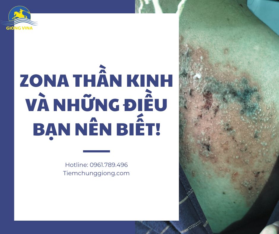 Zona thần kinh và những điều bạn nên biết!