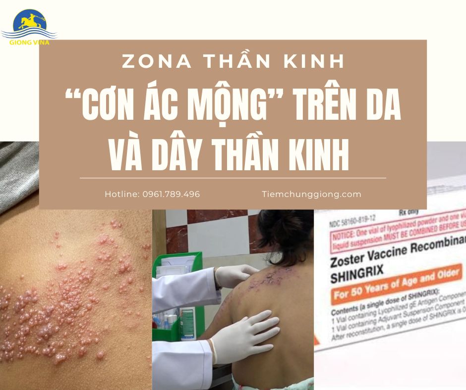 ZONA THẦN KINH – “CƠN ÁC MỘNG” TRÊN DA VÀ DÂY THẦN KINH 