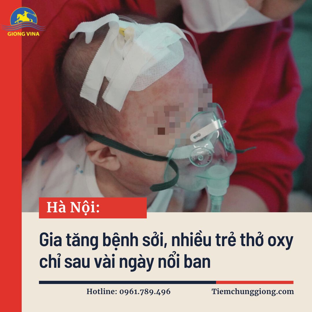 Hà Nội: Gia tăng bệnh sởi, nhiều trẻ thở oxy chỉ sau vài ngày nổi ban