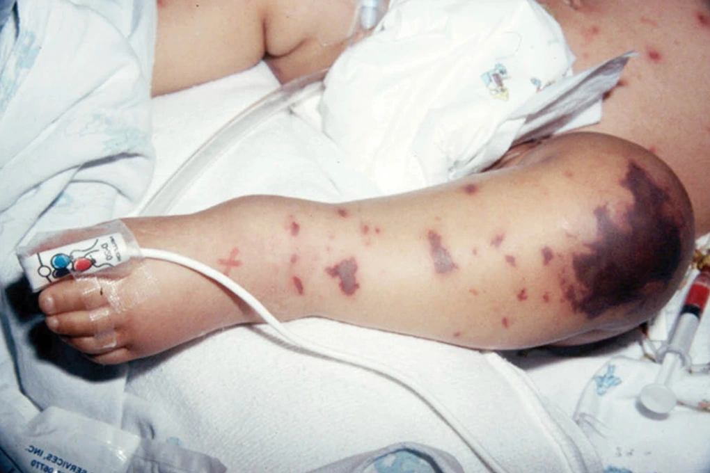 Đối phó với căn bệnh gây nhiễm trùng huyết, 135.000 ca tử vong/năm thế nào?