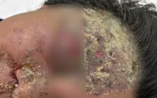 Zona thần kinh: Từ mụn nước nhỏ đến cơn ác mộng kéo dài