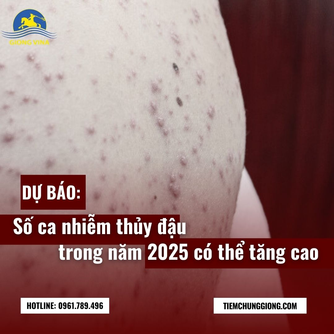 Dự báo số ca nhiễm Thủy đậu trong năm 2025 có thể tăng cao