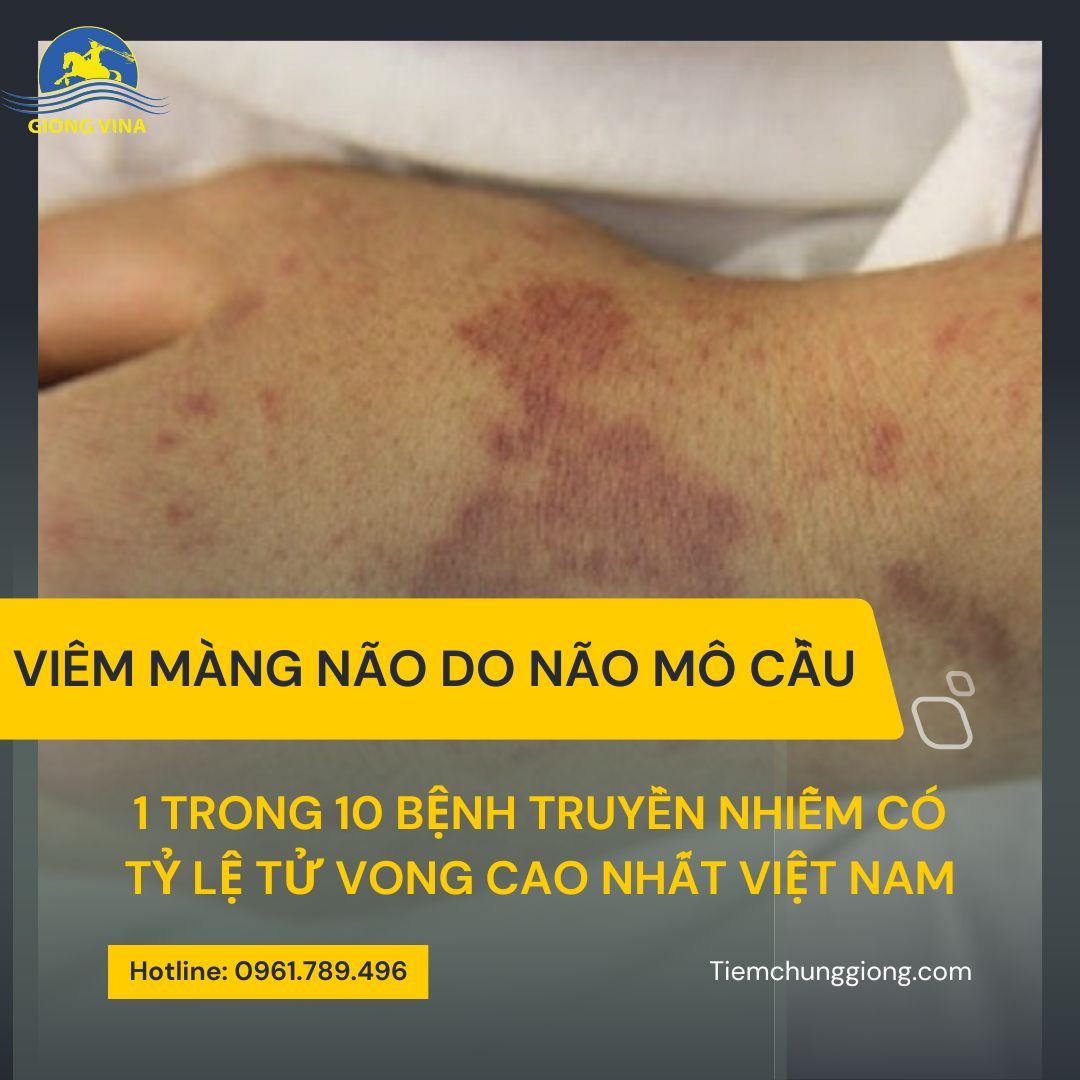 Viêm màng não do não mô cầu - 1 trong 10 bệnh truyền nhiễm có tỷ lệ tử vong cao nhất Việt Nam